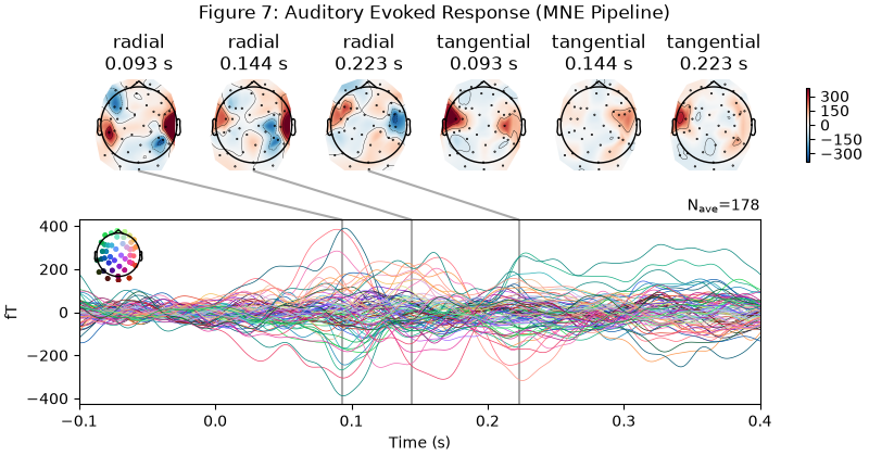 Figure 7: Auditory Evoked Response (MNE Pipeline), radial 0.093 s, radial 0.144 s, radial 0.223 s, tangential 0.093 s, tangential 0.144 s, tangential 0.223 s