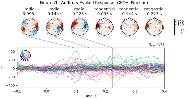 Figure 7b: Auditory Evoked Response (GEDAI Pipeline), radial 0.093 s, radial 0.144 s, radial 0.223 s, tangential 0.093 s, tangential 0.144 s, tangential 0.223 s