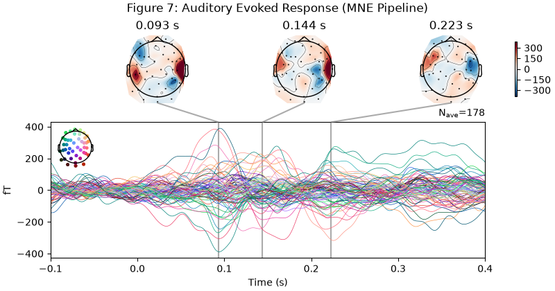 Figure 7: Auditory Evoked Response (MNE Pipeline), 0.093 s, 0.144 s, 0.223 s