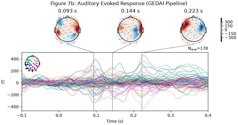 Figure 7b: Auditory Evoked Response (GEDAI Pipeline), 0.093 s, 0.144 s, 0.223 s